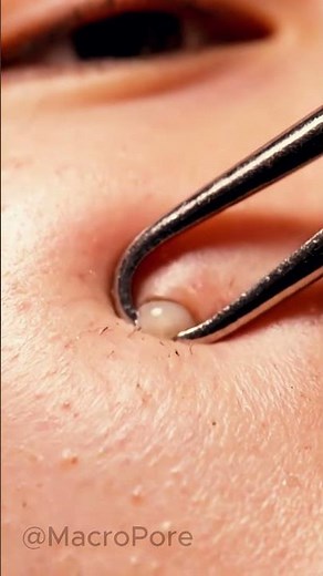 Professional Dermatology Extraction | Ultra-Realistic 4K Macro ASMR Pores