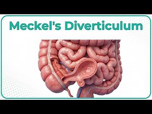 Meckel’s Diverticulum: Etiology, Clinical features, Diagnosis, Treatment, Complications: Surgery