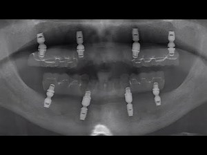 Fabricating and Inserting a Maxillary and a Mandibular Telescopic TRINIA® Prosthesis