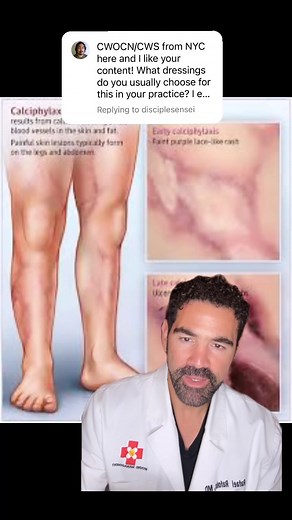 Calciphylaxis is a serious, uncommon disease in which calcium accumulates in small blood vessels of the fat and skin tissues. Calciphylaxis causes blood clots, painful skin ulcers and may cause serious infections that can lead to death. #medical #medicine #doctor #health #healthcare #hospital #doctors #nurse #woundcare #medicalstudent #neet #surgery #mbbs #medstudent #medschool #medico #science #medicalschool #pharmacy #surgeon #anatomy #heridas #nursing #biology #kidneydisease #education #love 