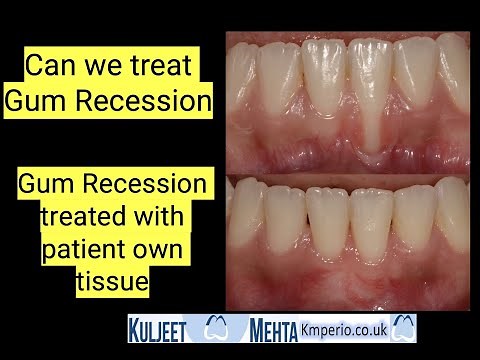 Treatment of Gum Recession After Orthodontic • Video • MEDtube.net