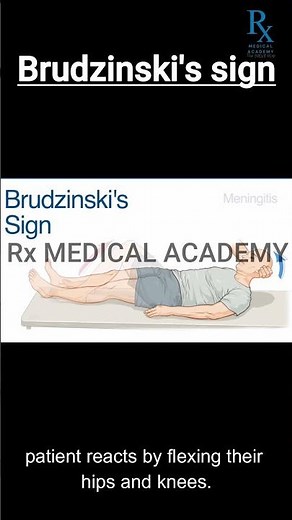 Brudzinski’s Sign | Clinical Test for Meningitis | Bedside Neurological Exam
