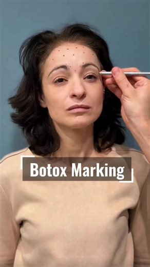 David Ganon on Instagram: "Je vous présente le cas d’une patiente de 43 ans présentant : ▪️ des rides du lion ▪️ des rides horizontales du front ▪️ une légère patte d’oie Lors de cette prise en charge, j’explique comment affaiblir précisément les muscles corrugateurs et le muscle procerus, responsables des rides du lion, traiter les rides horizontales marquées du front et favoriser le soulèvement naturel des sourcils avec le point Fox Eye. 👉 Chaque injection doit être une approche personnalisée