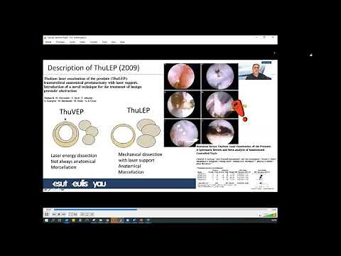 UROwebinar: Laser Endoscopic Anatomic Enucleation of Prostate (AEEP)