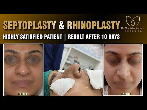 Rhinoplasty Transformation: From Wide & Bulbous to Beautiful Nose | Rhinoplasty Surgery Before After
