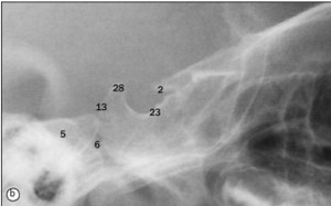 Silla turca, proyección lateral RX
