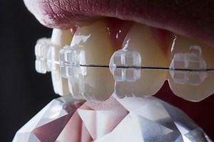 Braces Colours – Everything You Need to Know! - Dental Aware Australia