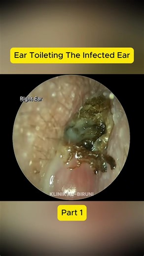Part 1 Ear Toileting The Infected Ear #earwax #earwaxremoval #earcleaning #eardioctor #audiology