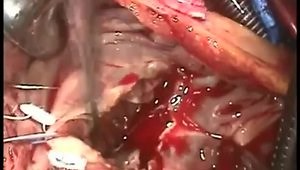 Tricuspid Valve Replacement for Severe Endocarditis