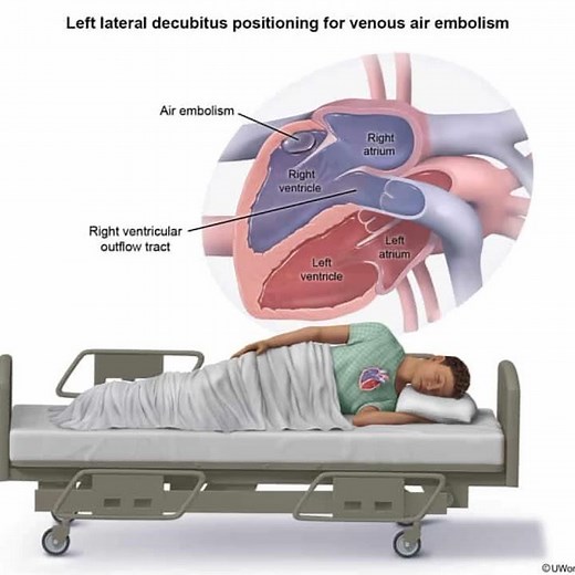 Air embolism left lateral decubitis position #airembolism