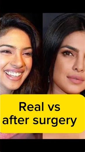 Real vs after surgery#alia butt#praniyka chopra#noreh