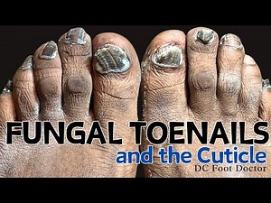 Fungal Toenails and the Cuticle