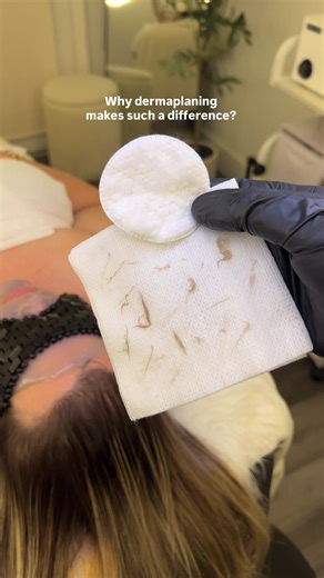 Why dermaplaning makes such a difference ✨ Dermaplaning removes the buildup of dead skin cells and fine facial hair that can make the skin look dull and uneven. By gently exfoliating the surface of the skin, this treatment helps improve texture, enhance glow and allows skincare products to absorb more effectively. The result: smoother, brighter and healthier looking skin. ByDa Beauty #bydabeauty #facialtreatment #dermaplaning #skincare