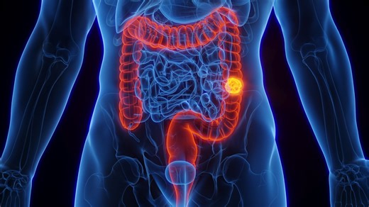 What are the first signs of colon cancer? Common symptoms, screening and how to prevent