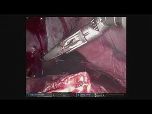 Robotic Splenectomy