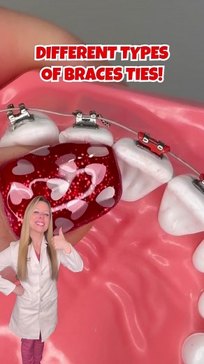 Types of Braces Ties: Regular, Crisscross, Steel, and More