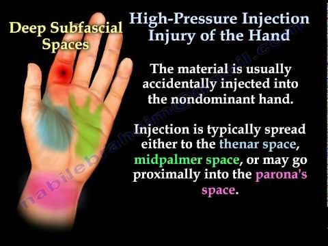 HAND High-Pressure Injection Injury - Everything You Need To Know - Dr. Nabil Ebraheim