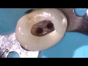 Endodontic treatment on the upper first premolar