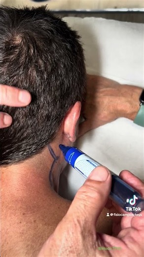 PERSISTENT CERVICALGIA, VERTIGO, HEADACHES