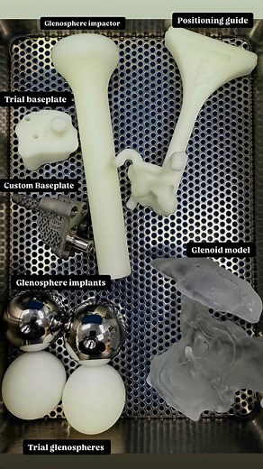 Custom implants can be useful for patients with severe bony deformity or bone loss… I recently did two reverse total shoulder replacements utilizing a state of the art custom implant system. My patients get a CT which is then uploaded into a pre-operative planning software. Design engineers make an initial plan which I review with them and make adjustments or modifications. The company manufactures the custom implants and custom guides to ensure precise implant placement in the operating room. E