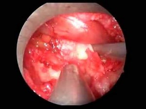 L5-S1 Disc Removal Using Endoscopic Method Due Ton Non-Contained Hernia • Video • MEDtube.net