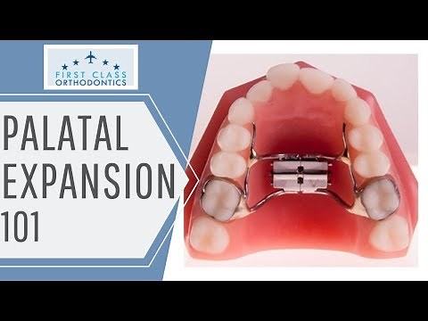 [FIRST CLASS ORTHODONTICS] | Palatal Expander 101