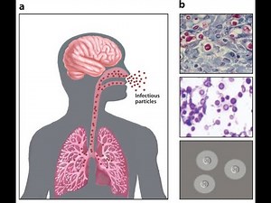 Cryptococcosis Infection ; Definition, Causes, Morphology, Clinical features, Diagnosis, treatment