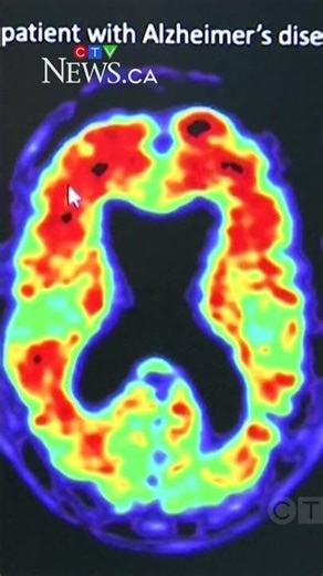 Health Canada approves drug that may slow the progression of dementia