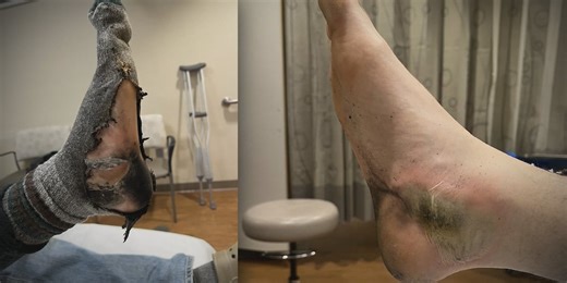 Minnesota man suffers burns after rechargeable insoles explode inside boots