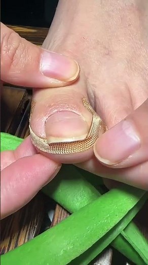 Toenail Pain Solution 🦶 Quick & Safe Ingrown Nail Fix Using Simple Method