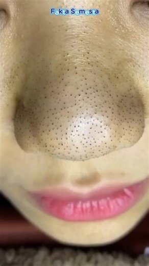 Don't Squeeze Blackheads Randomly, This is the Right Way to Do It #uniquefacts #uniqueinfo