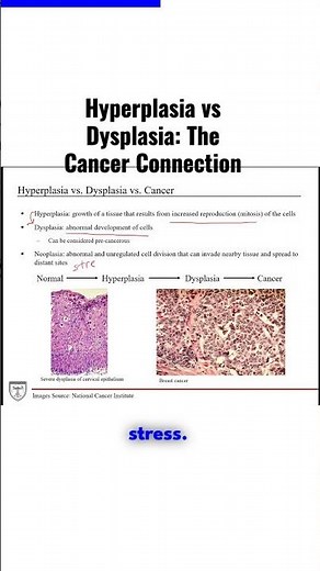 Hyperplasia vs Dysplasia: The Cancer Connection
