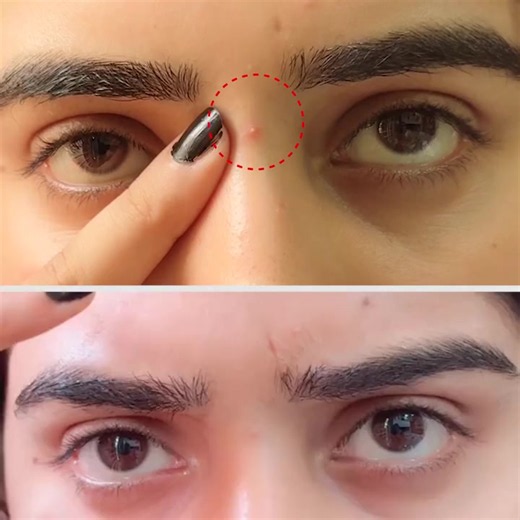 Home Remedy for Acne Removal at Home