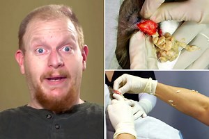 Dr Pimple Popper sprayed with pus as exploding 'goose egg' cyst propels rotten fluid from man's head
