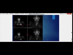 ectopic parathyroid adenoma on dual phase Tc Sestamibi scan--2nd case