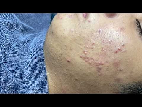 Relax Every Day | Satisfying Blackhead Removal | Relaxing Acne Extraction