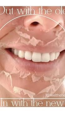 VI Chemical Peel before and after Video