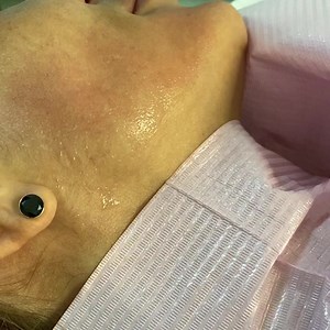 DERMAPEN BABY FACE LASER LUMINA ROȘIE ✔️ Beneficii : stimulează colagenul , tratează semnele cauzate de acnee , porii dilatați , excesul de seboree Preț :200€ Programări :0722296007 | Clinica Beauty Art Aesthetics