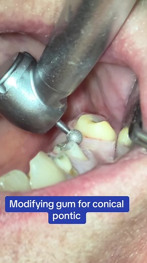 Ovate Pontics: Enhancing Dental Aesthetics and Functionality