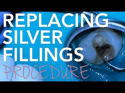 Silver Filling Removal