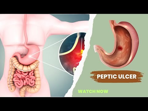 Peptic ulcer disease – causes, symptoms, diagnosis & treatment.