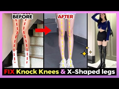 🔥BEST EXERCISE TO FIX KNOCK KNEES & X-Shaped legs | Get Straight & Longer Legs, Perfect Legs Shape