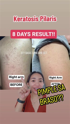 Paano Maalis ang Pimples sa Braso: Keratosis Pilaris