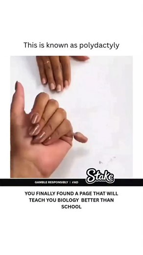 BIOLOGY | HEALTH | MEDICAL on Instagram: "Polydactyly is a birth defect characterized by the presence of extra fingers or toes. It's a relatively common condition, with the extra digits usually appearing on the pinky finger side of the hand or the little toe side of the foot. However, it can also occur on the thumb or big toe side or even in the middle of the hand or foot. Dm for credit or removal"