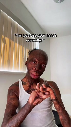 Mastering Hand Movements: Overcoming Disabilities