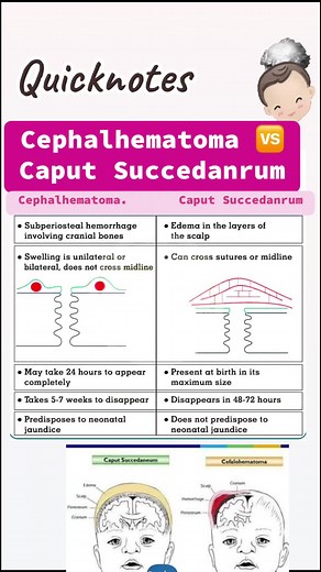 How can you tell the difference between cephalohematoma and caput? Caput succedaneum is similar to cephalohematoma as both involve unusual bumps or swelling on the newborn's head. However, the main difference is that lumps caused by bleeding under the scalp is cephalohematoma, whereas lumps caused by scalp swelling due to pressure is known as caput succedaneum. ✅Caput succedaneum • Soft tissue edema • Edema extends across suture lines • Present at birth • Poorly defined borders • May include ecc
