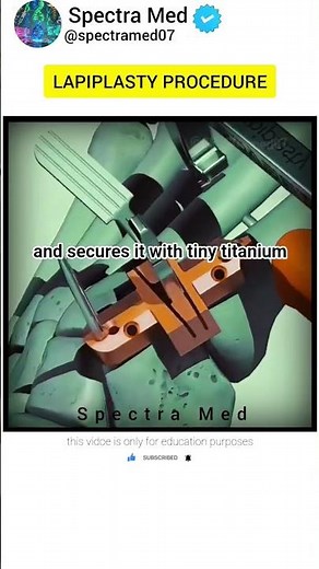 Foot Fracture Surgery Explained Step-by-Step | 3D Medical Animation#biology #science #anatomy #3d