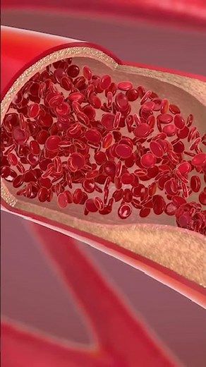 Syphilis infects your blood vessels