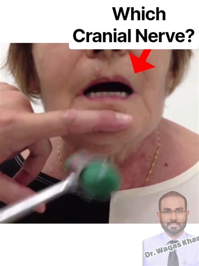 Exaggerated Jaw Jerk = UMN Lesion 🧠