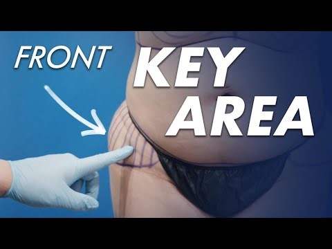 Liposuction in the Key Area: Enhancing the Butt without a BBL
